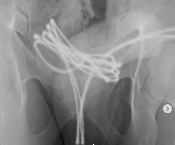 Jovem de 21 anos é internado após introduzir cabo USB na uretra em busca de prazer s3xual